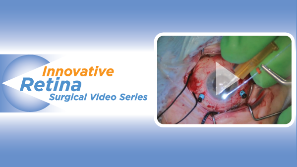 Innovative Retina Surgical Video Series